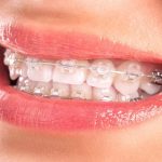 Ortodoncia Estética